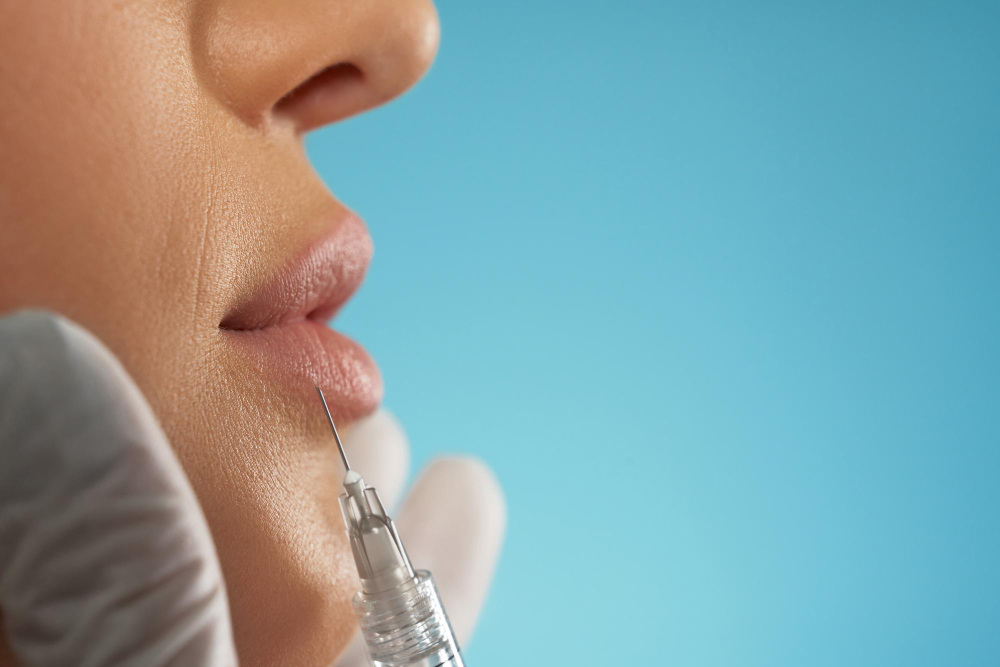 Prim-plan cu buzele unei paciente și o seringă pregătită pentru injectarea acidului hialuronic